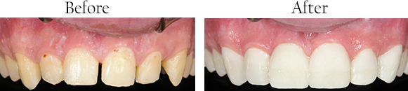 St. Louis Dental Implants