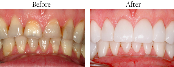 Dental Implants 63109